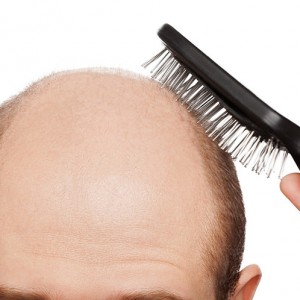 почему у мужчин выпадают волосы